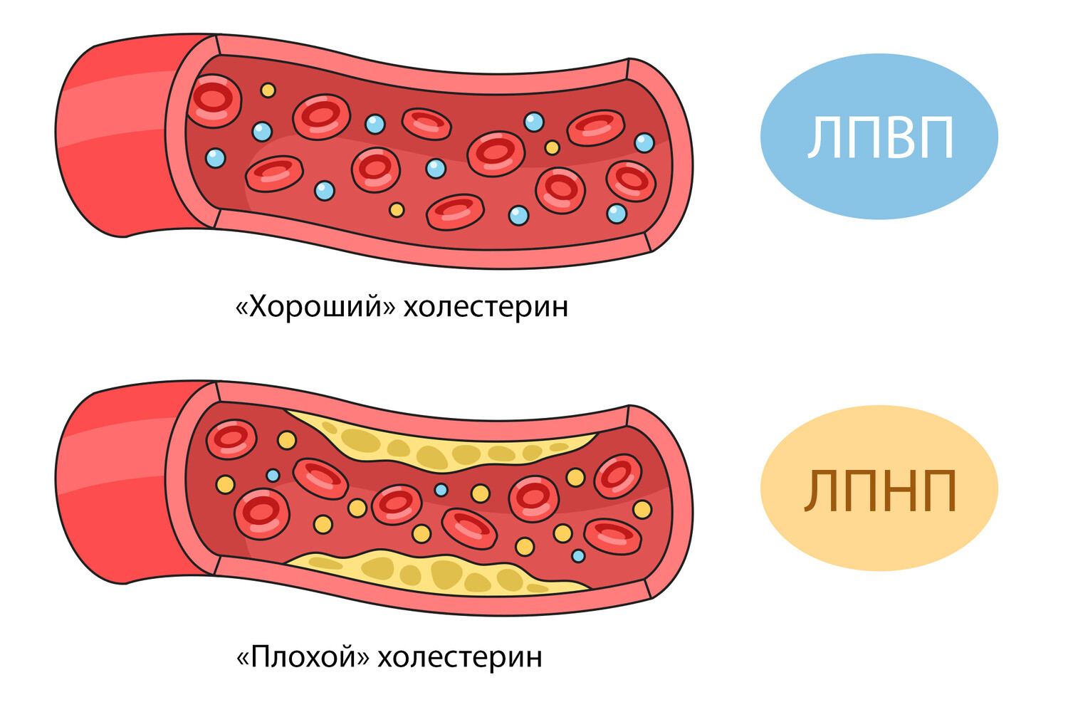 Уколы vs статины: как сегодня лечат «плохой» холестерин - 2